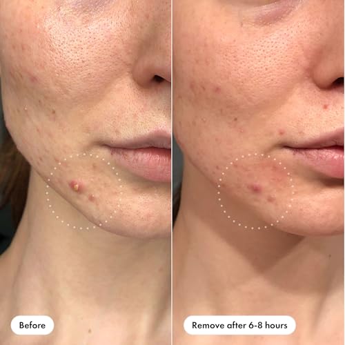 Mighty Patch™ Invisible+ Patch - Daytime Hydrocolloid Acne Pimple Patches for Covering Zits and Blemishes, Ultra Thin Spot Stickers for Face and Skin (24 Medium and 15 Small Patches)