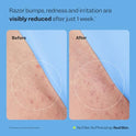 Peach Slices - Smoothing Solution Ingrown Hair Treatment (1.69 oz) - Smooth, Relieve, Soften Skin - 360 Roller - BHA, AHA, PHA, Niacinamide, Licorice - Vegan & Cruelty Free - Korean Skin Care & Beauty