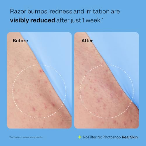 Peach Slices - Smoothing Solution Ingrown Hair Treatment (1.69 oz) - Smooth, Relieve, Soften Skin - 360 Roller - BHA, AHA, PHA, Niacinamide, Licorice - Vegan & Cruelty Free - Korean Skin Care & Beauty