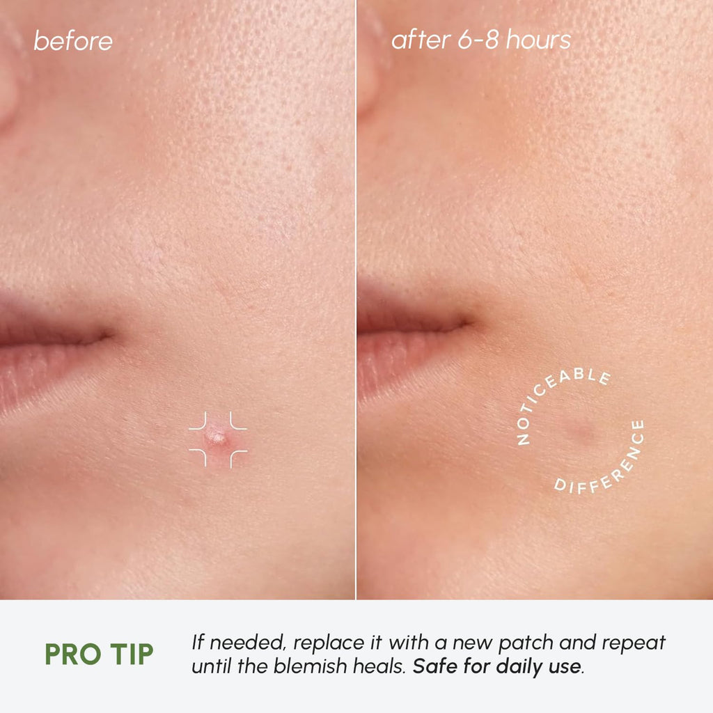 MAREE Pimple Patches for Face - Acne Clearing Device - Clear Acne Patches for Face - Invisible Hydrocolloid Patch Parches Para Acne Stickers Zit Dots - Cystic Zit Healing Blemish Pinple Covers