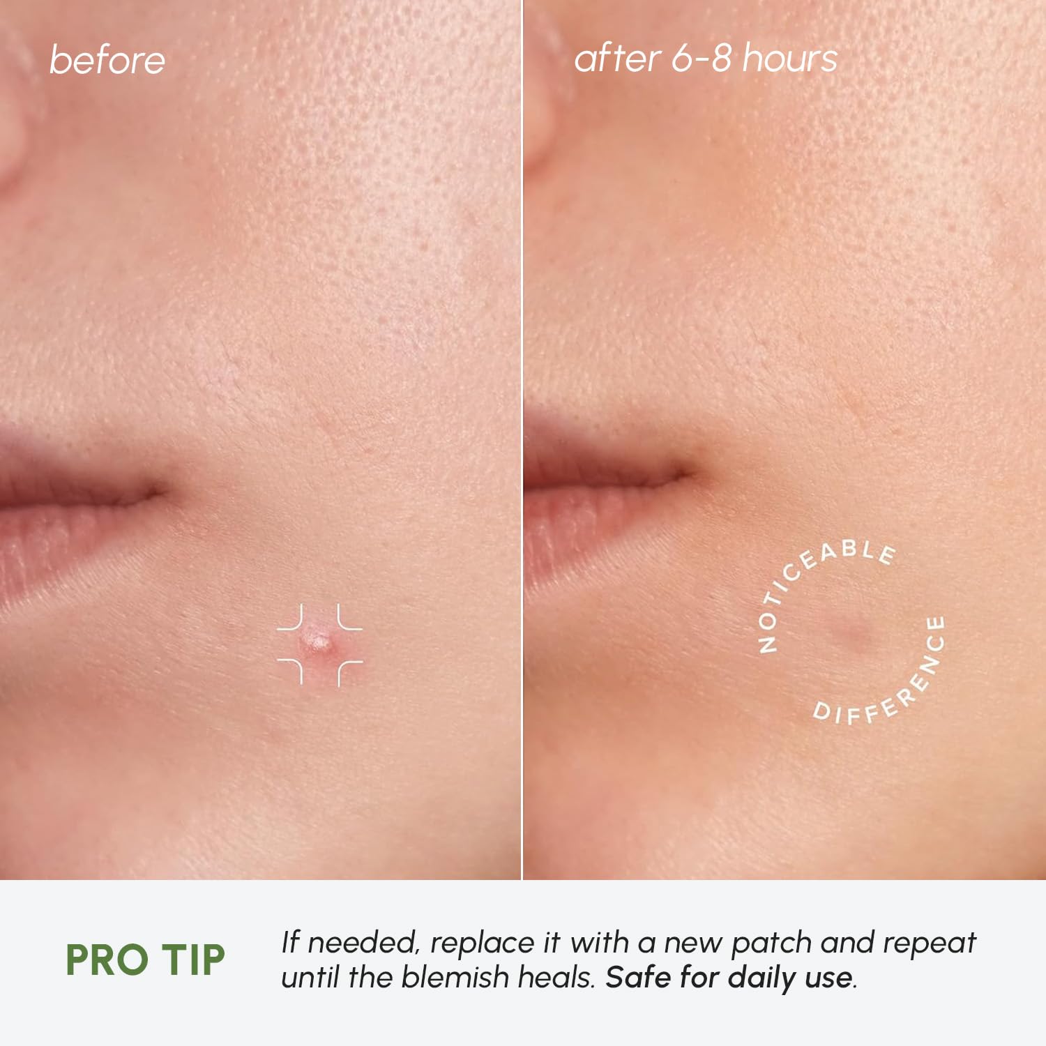 MAREE Pimple Patches for Face - Acne Clearing Device - Clear Acne Patches for Face - Invisible Hydrocolloid Patch Parches Para Acne Stickers Zit Dots - Cystic Zit Healing Blemish Pinple Covers